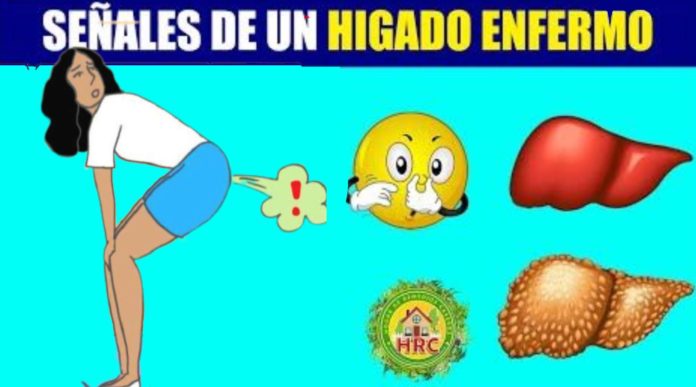 Signos De Hígado Enfermo Pero Lo Peor Es Que No Todos Lo Saben Virolico 2266